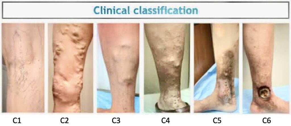 Classificação CEAP úlcera varicosa