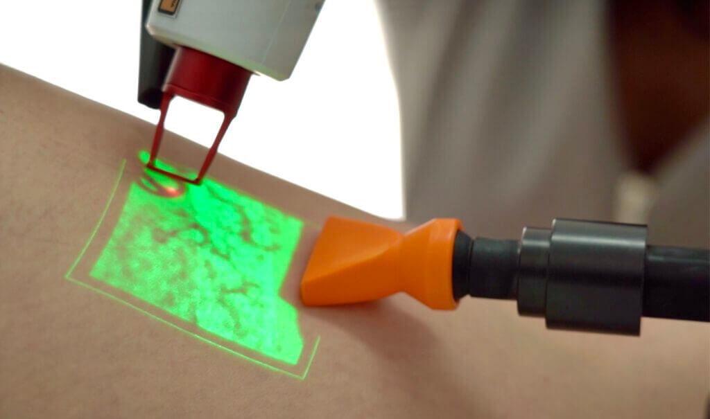 laser para varizes