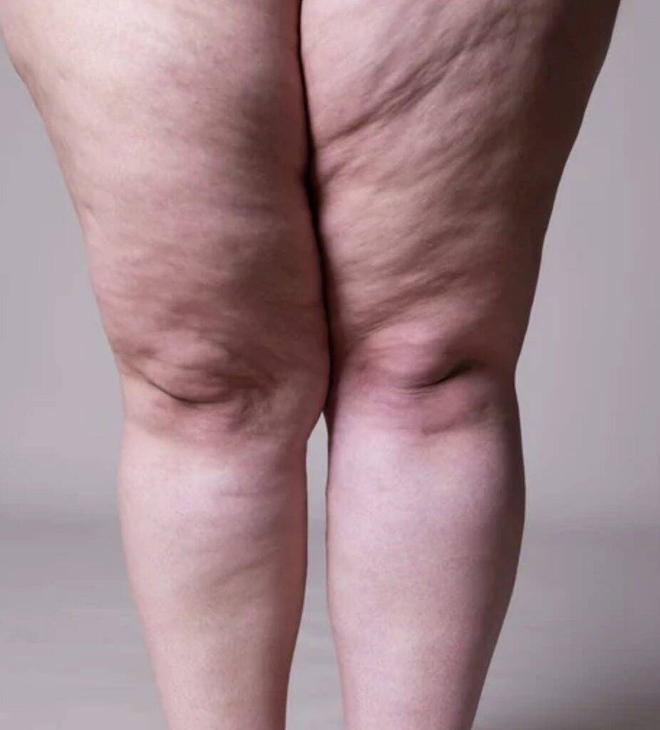 Lipedema