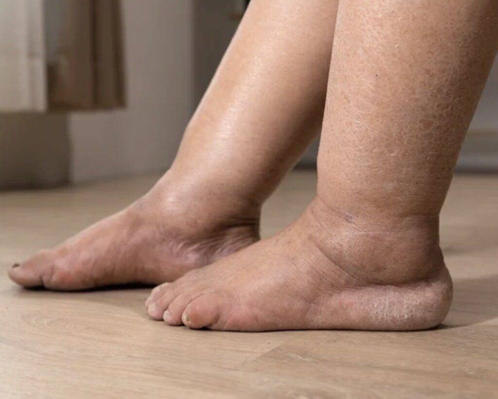 linfedema