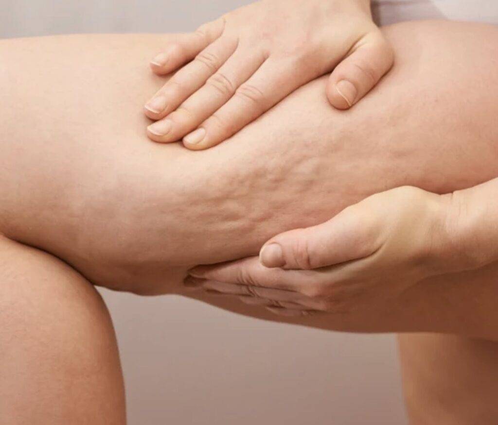 celulite ou lipedema?