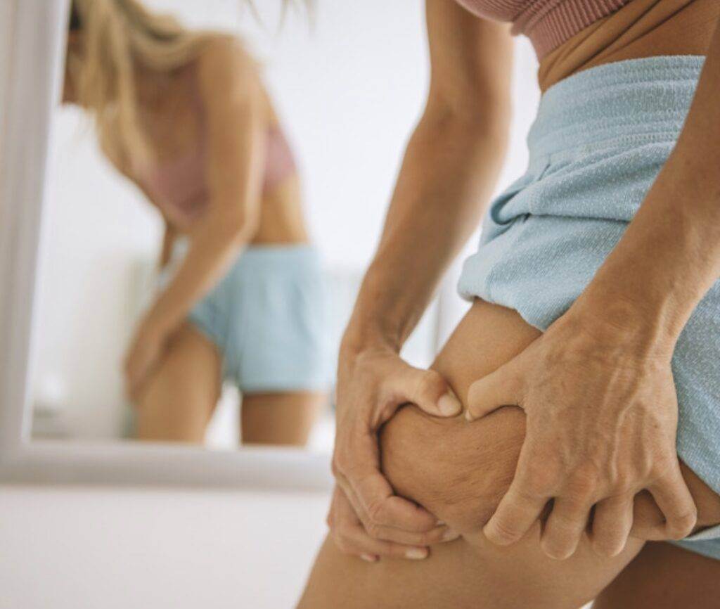 lipedema