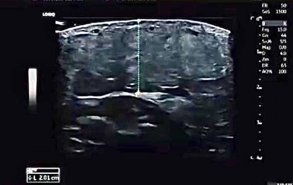 ultrassom para lipedema