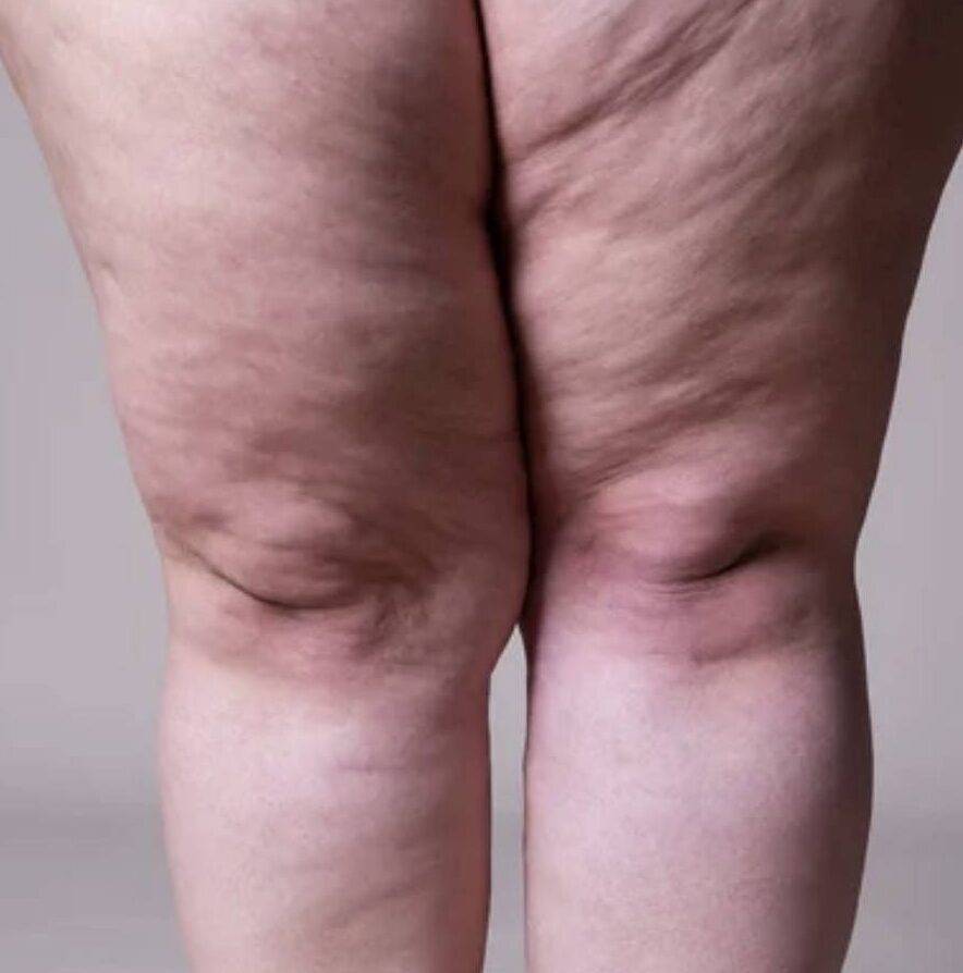 Lipedema