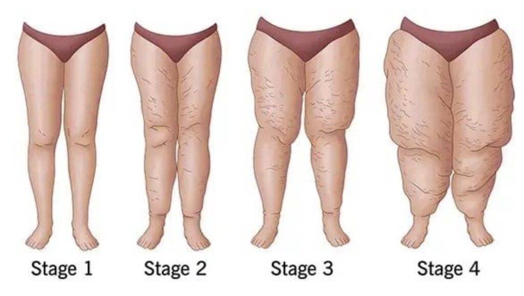 Lipedema